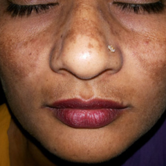 Hyperpigmentation